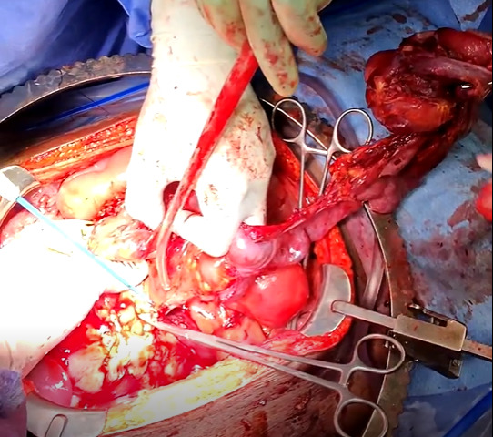 A person holding a surgical instrument AI-generated content may be incorrect.