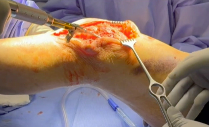 A person's knee surgery AI-generated content may be incorrect.