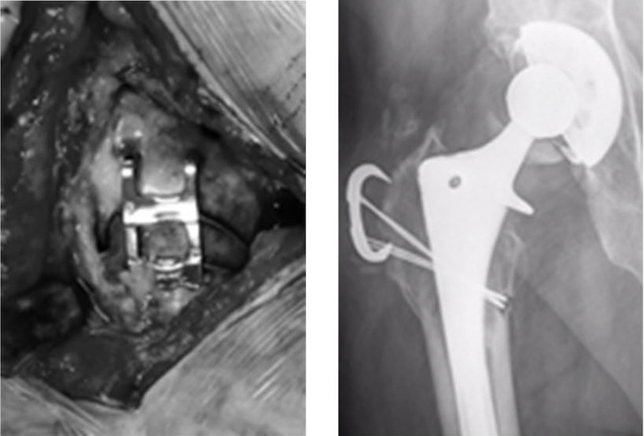 X-ray of a bone with a clip Description automatically generated