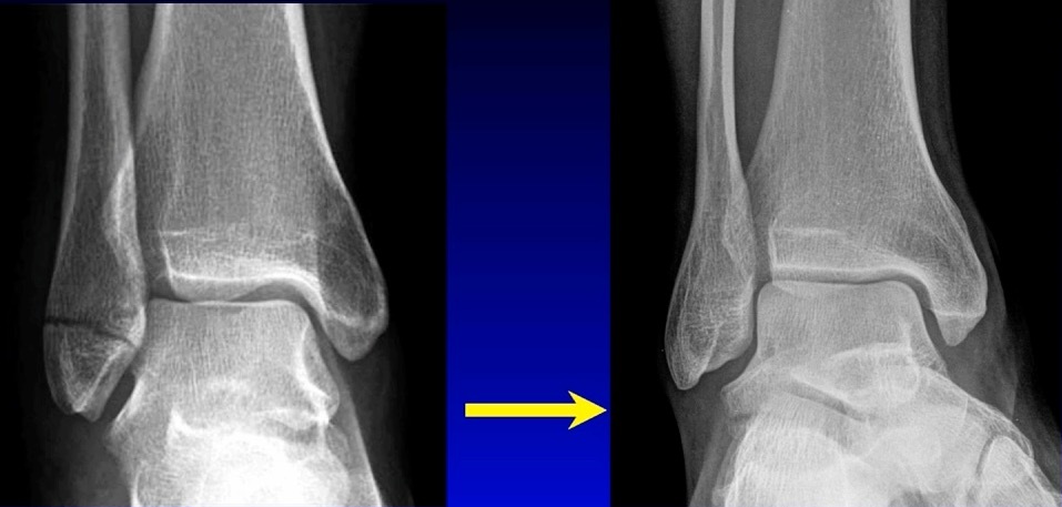 A close-up of a x-ray of a foot AI-generated content may be incorrect.