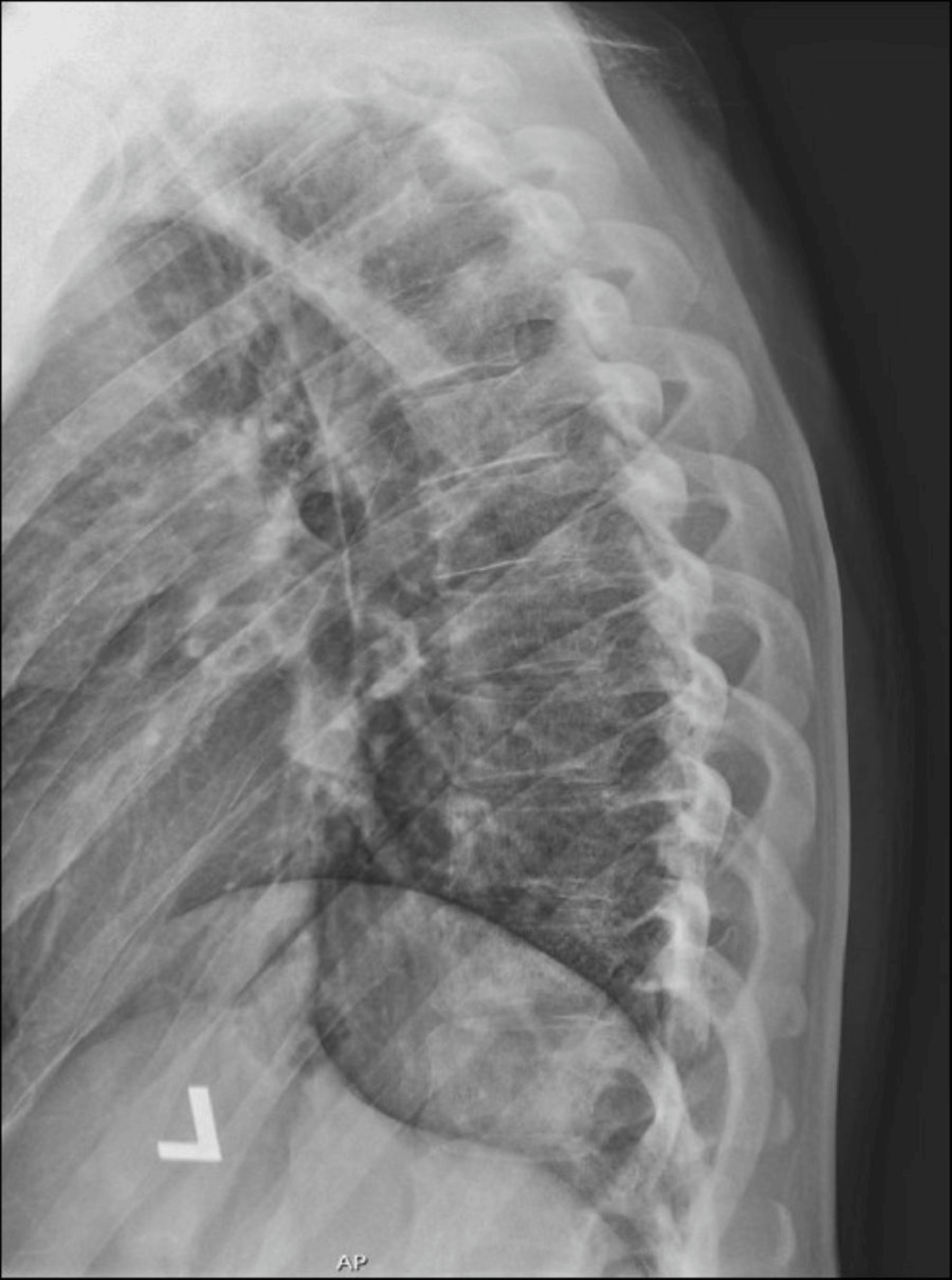 Thoracic-spine-lateral-view.-T4-vertebral-body-interpreted-as-normal.