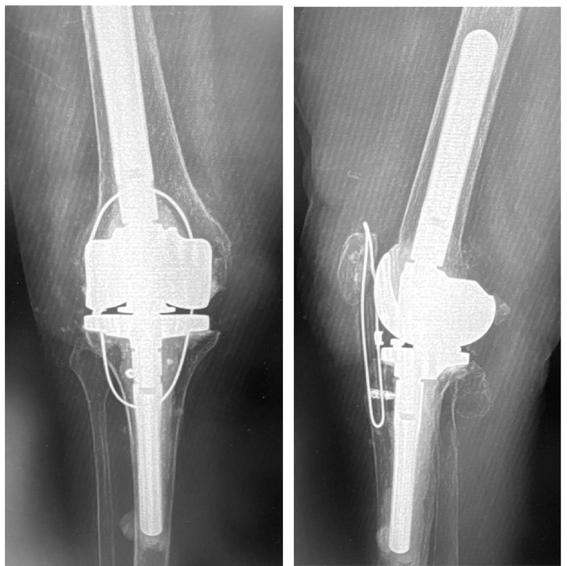 X-ray of a bone AI-generated content may be incorrect.
