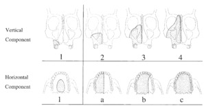 The Zygomatic Implant Perforated (ZIP) flap for rehabilitation of ...
