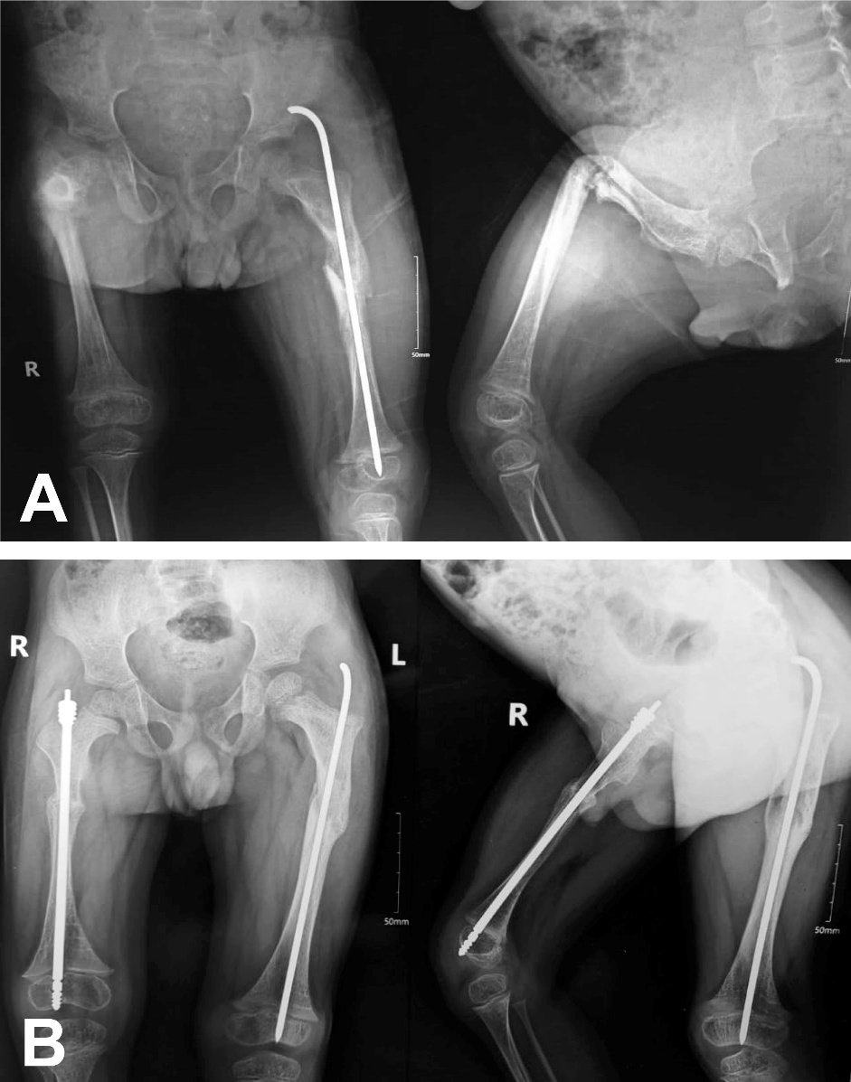 Pre-operative and post-operative x-rays of a child's femur showing correction of severe deformity with Fassier-Duval telescopic nail