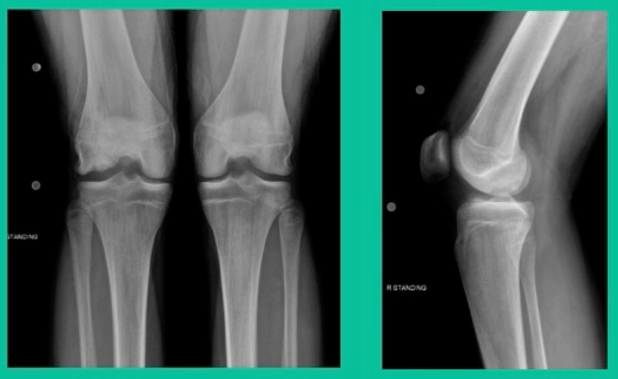 X-ray of knee joint and knee joint AI-generated content may be incorrect.