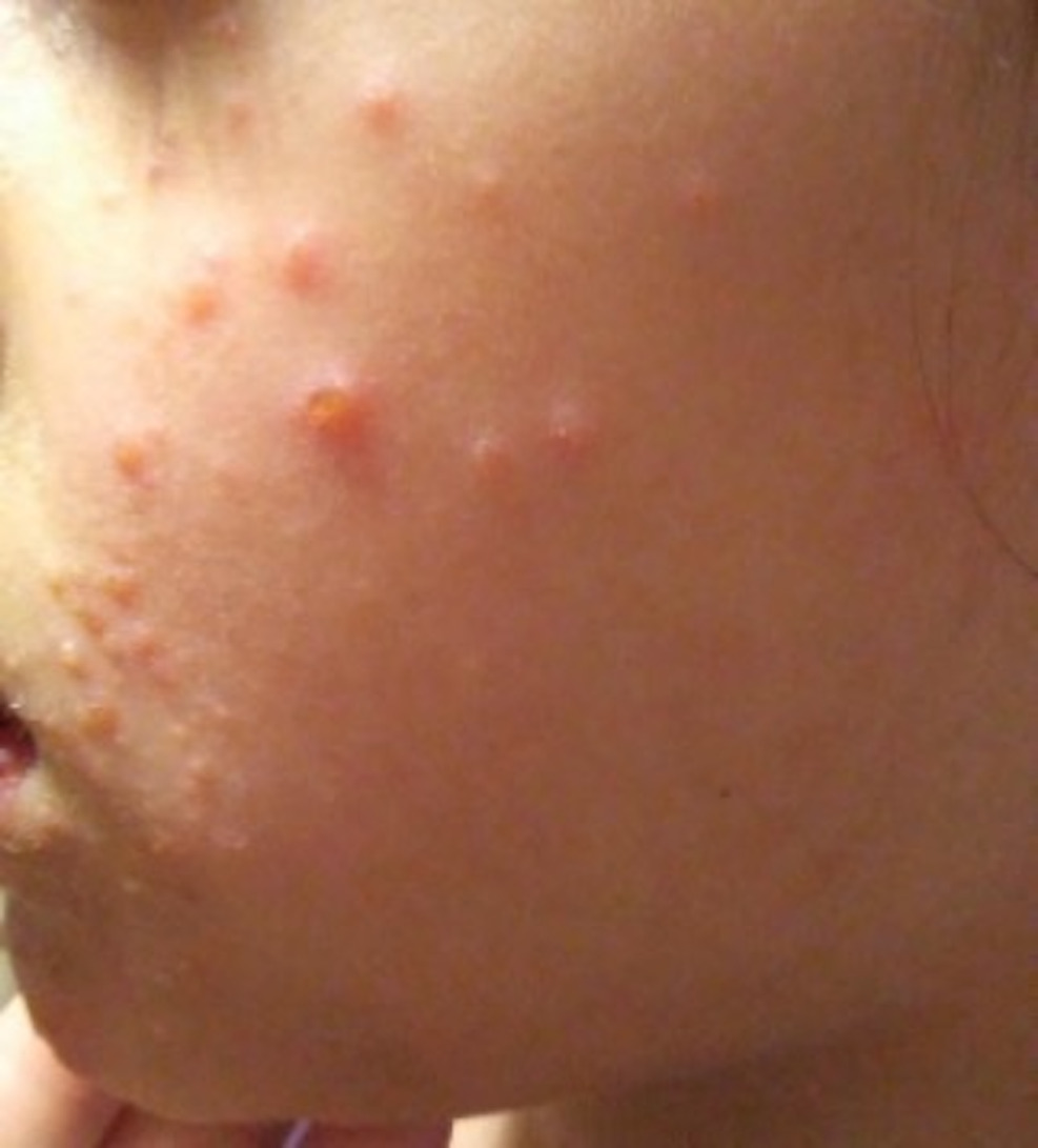 Close-up of a child's face with red bumps on it AI-generated content may be incorrect.