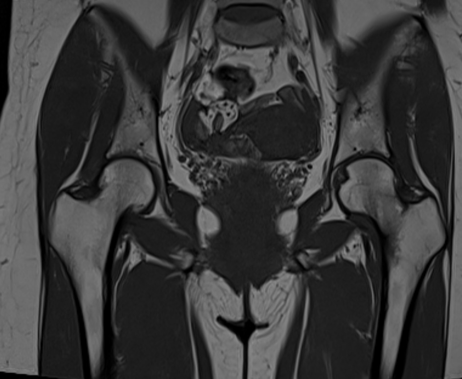 C:UsersdnlieOneDriveDesktopĐinh Ngọc LiêmBệnh nhân nghiên cứuStressed femur fracture (Đinh Hương Thảo)đinh hương thảo 2.png