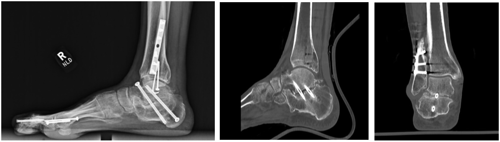 A x-ray of a foot AI-generated content may be incorrect.