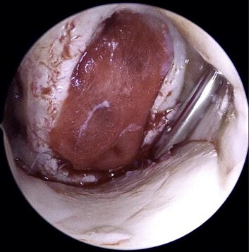 An update on osteochondritis dissecans of the knee | Published in  Orthopedic Reviews