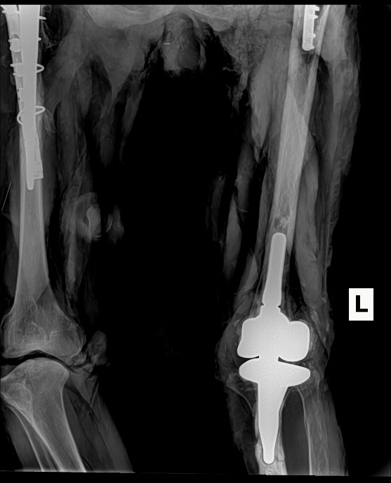 X-ray of a broken leg AI-generated content may be incorrect.