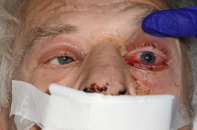 A close-up of a person with a bandaged face Description automatically generated