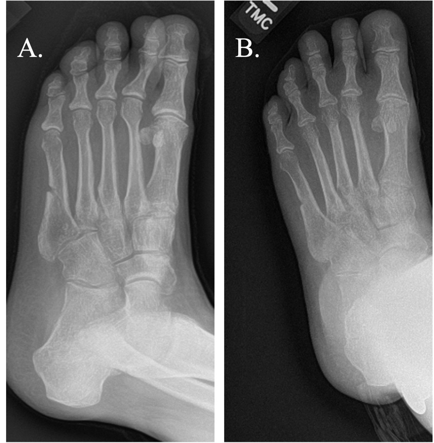 X-ray of a foot and foot bones Description automatically generated