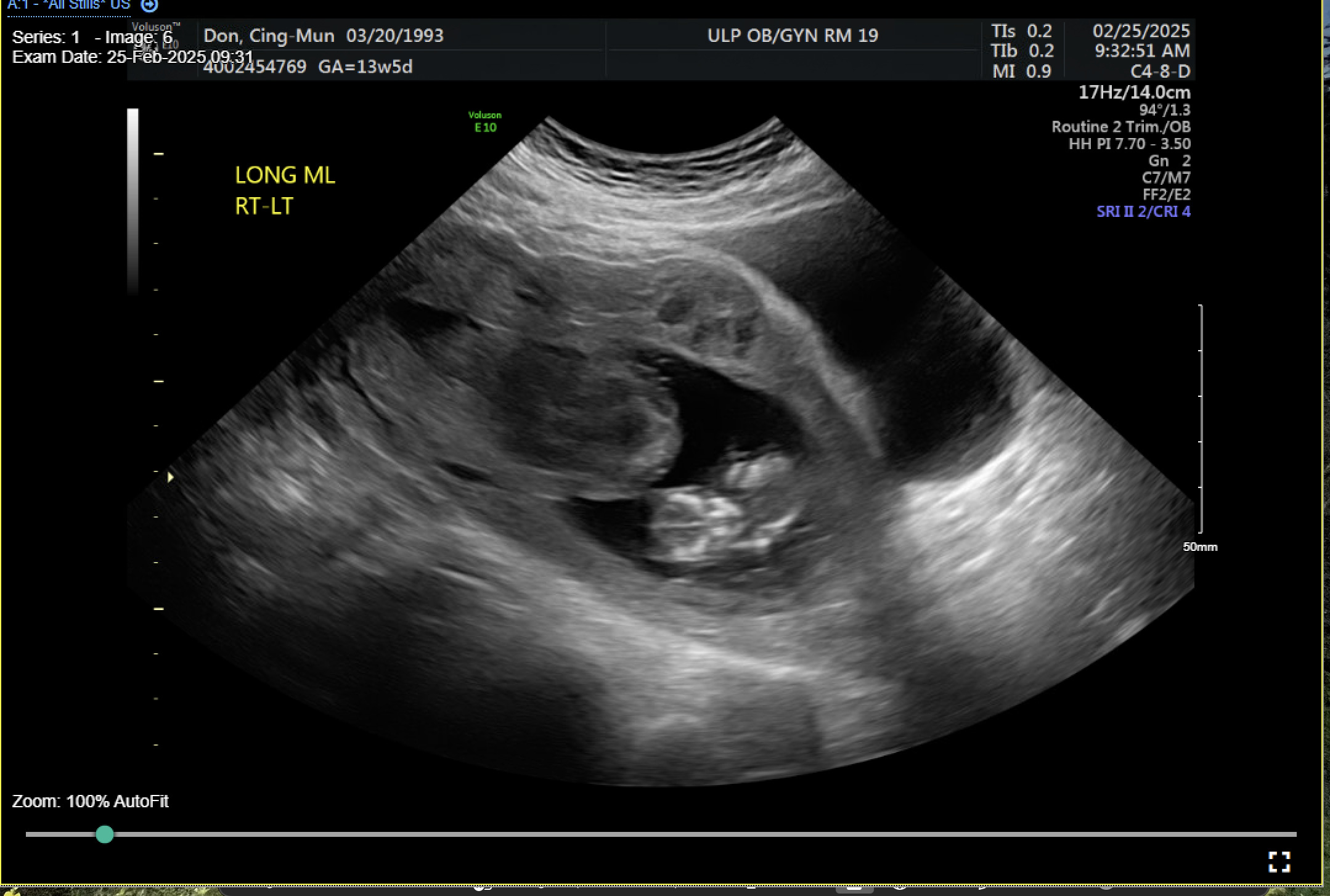 A ultrasound image of a baby AI-generated content may be incorrect.