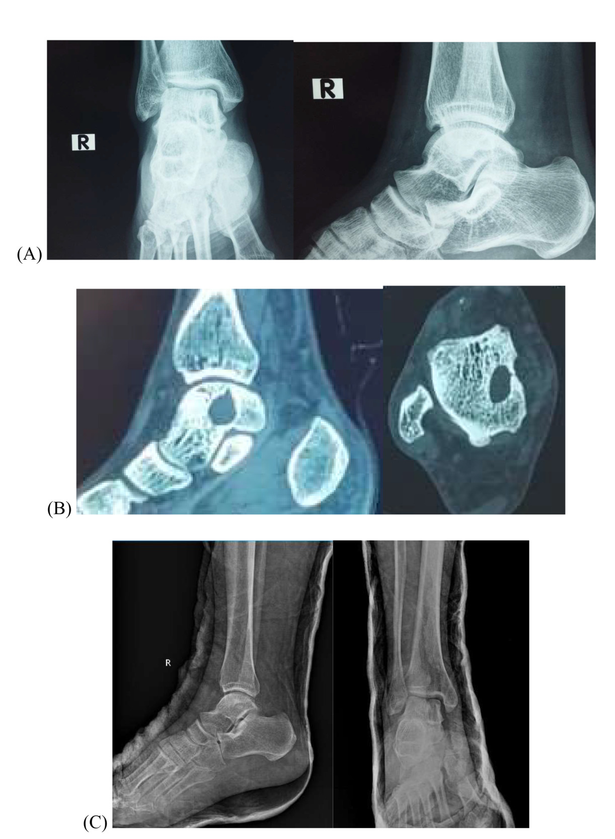 ARTHROSCOPIC ANKLE JOINT AND ARTIFICIAL BONE GRAFTING FOR TREATMENT