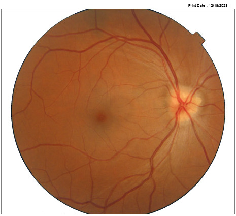 A close-up of a red vein Description automatically generated