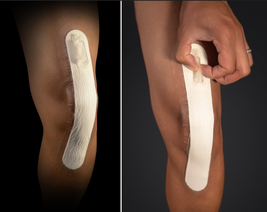 silver dressing after knee replacement Surgical Dressings | Silver Dressings