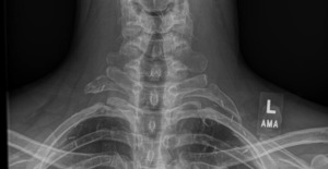 THE RIB THAT WOULDN'T QUIT: A CHIROPRACTIC PERSPECTIVE ON RECURRENT ...