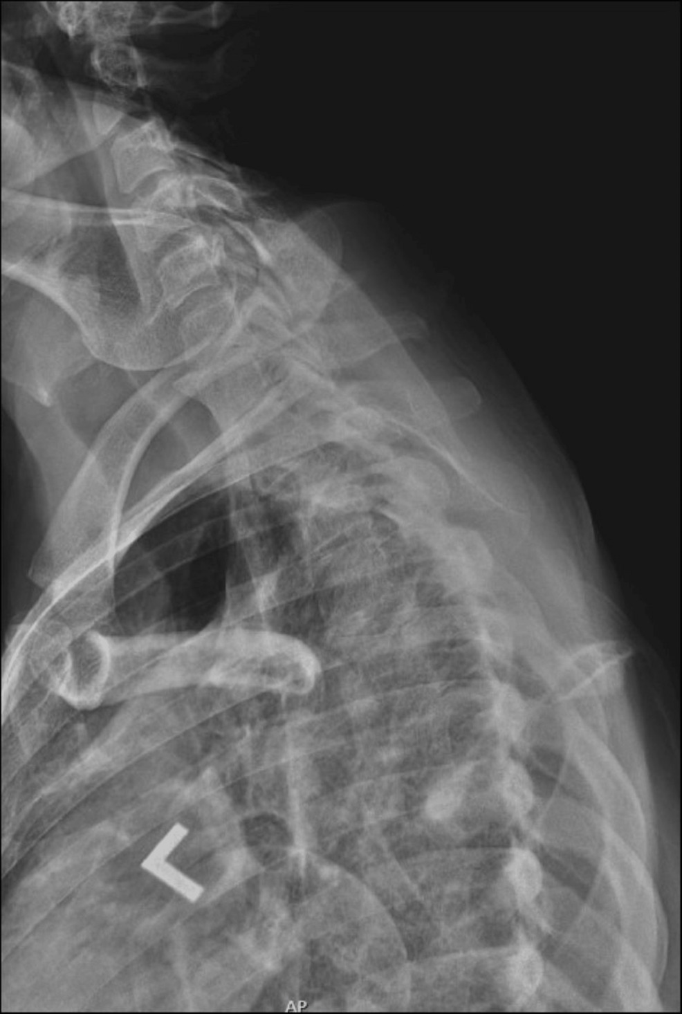 Thoracic-spine-swimmer's-view.-T4-vertebral-body-interpreted-as-normal.