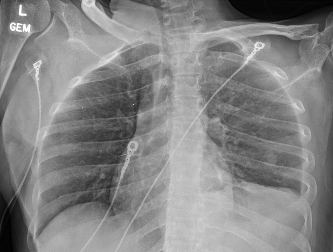 X-ray of a person's chest Description automatically generated
