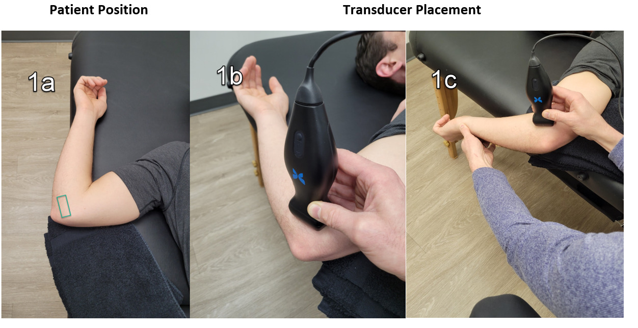 The Use of MSK Ultrasound in the Evaluation of Elbow Ulnar Collateral ...