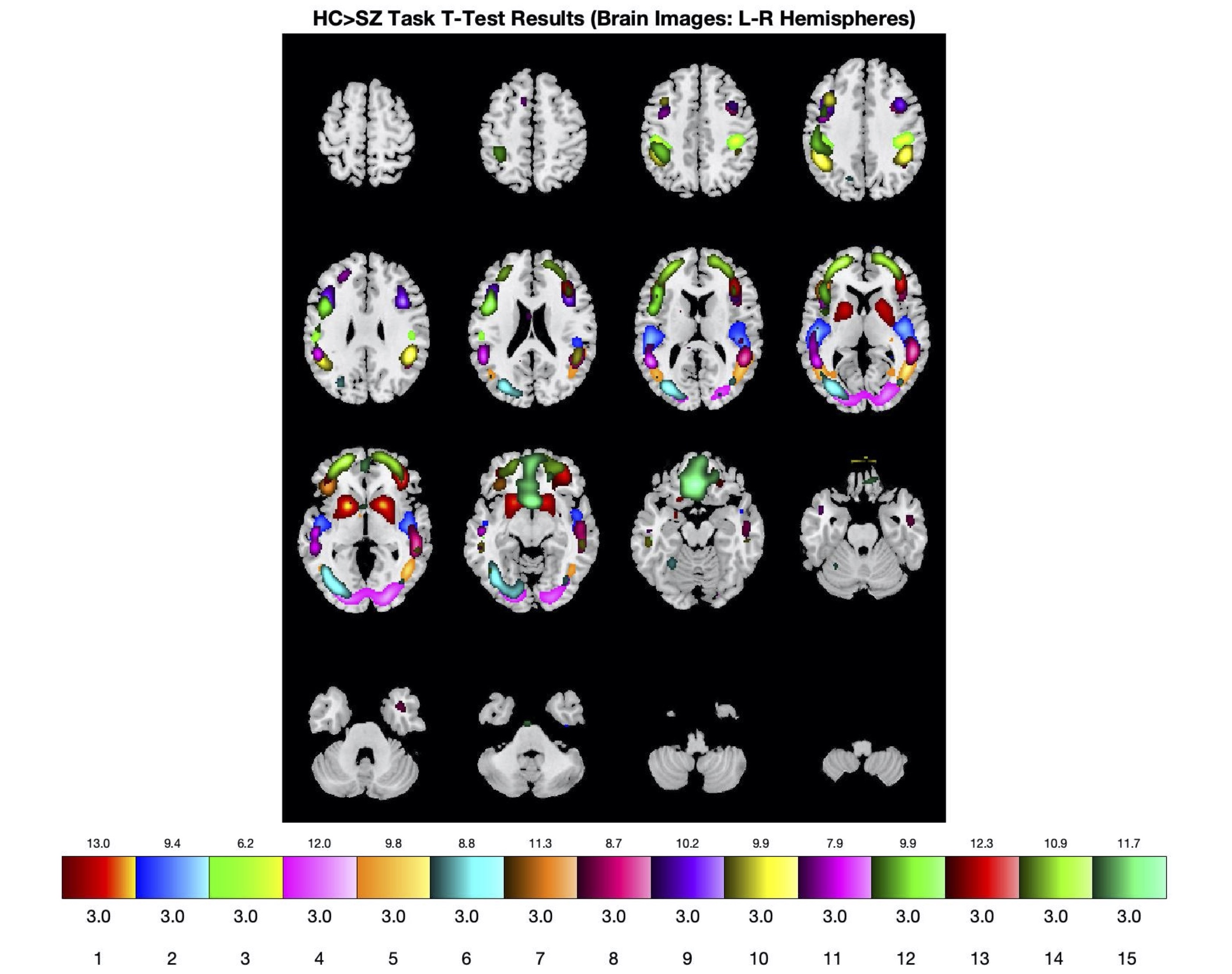 Fully automated estimation of fMRI-guided SPECT brain networks and