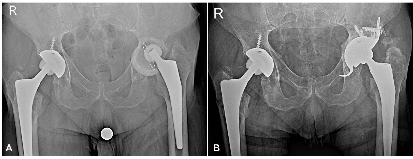 X-ray of a hip joint AI-generated content may be incorrect.