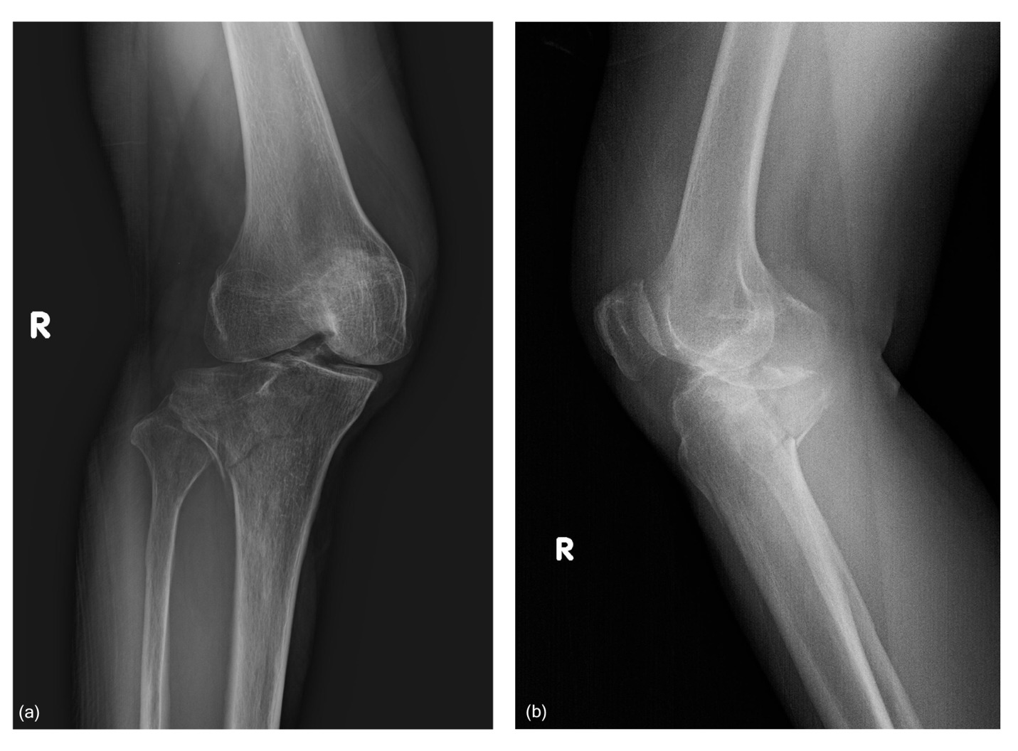 X-ray of a knee and knee joint AI-generated content may be incorrect.