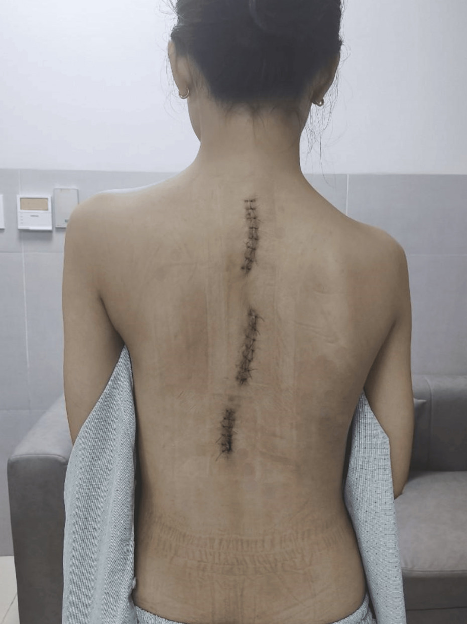 A back of a person with scar on her back AI-generated content may be incorrect.