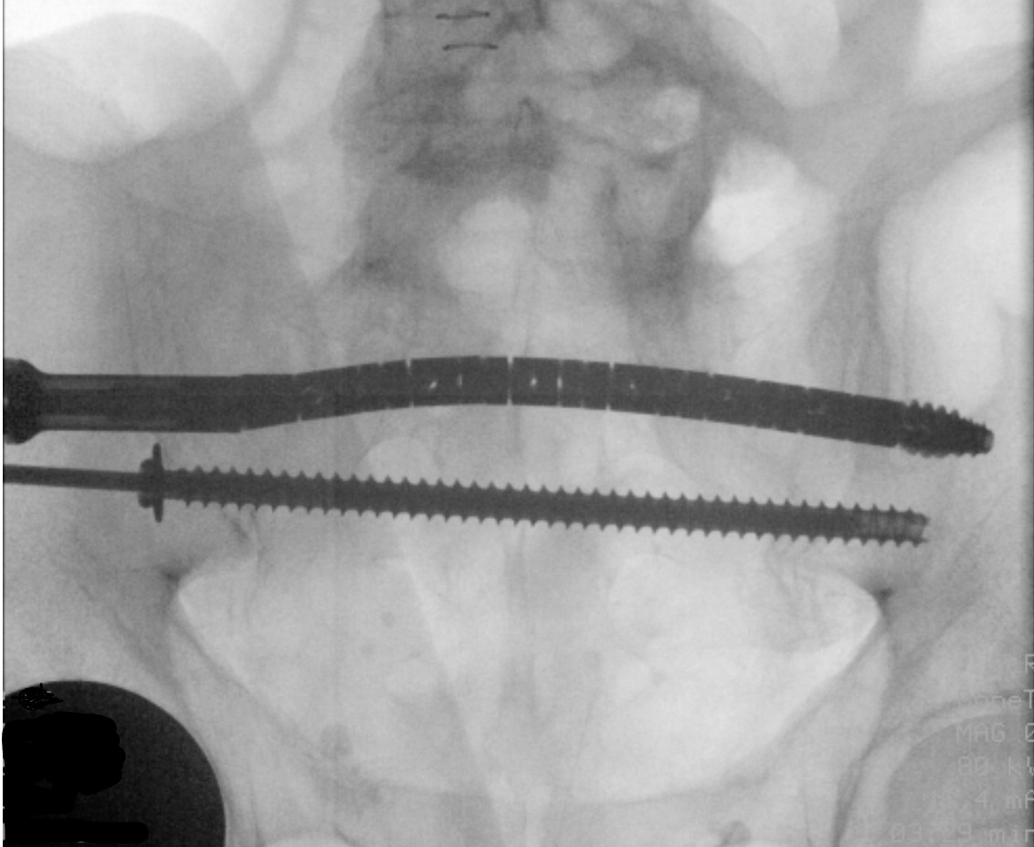 X-ray of a person's pelvis Description automatically generated