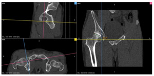 Morphological Characteristics of the Vietnamese Adult Human Acetabulum ...