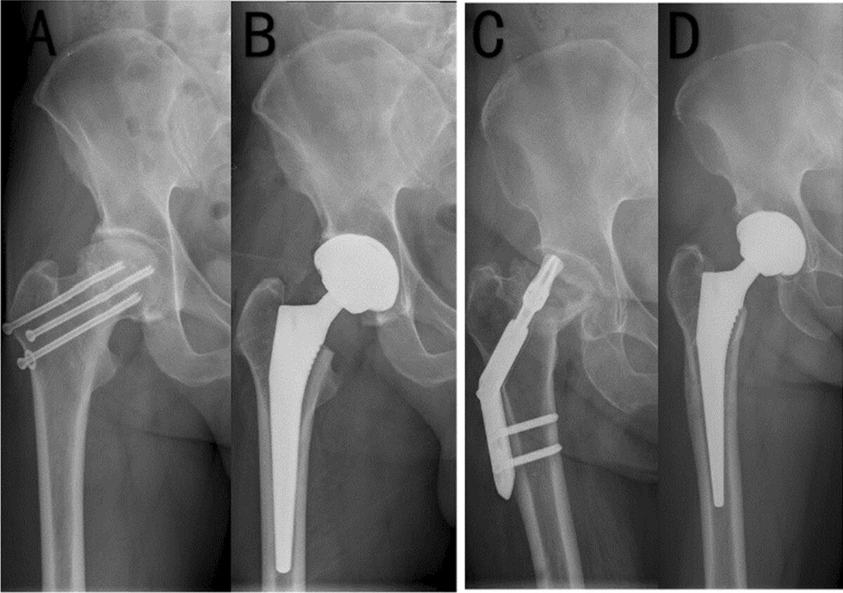 Total hip arthroplasty for failed internal fixation of femoral neck fracture: a retrospective study with 2--14 years' follow-up of 345 patients | Journal of Orthopaedic Surgery and Research | Full Text