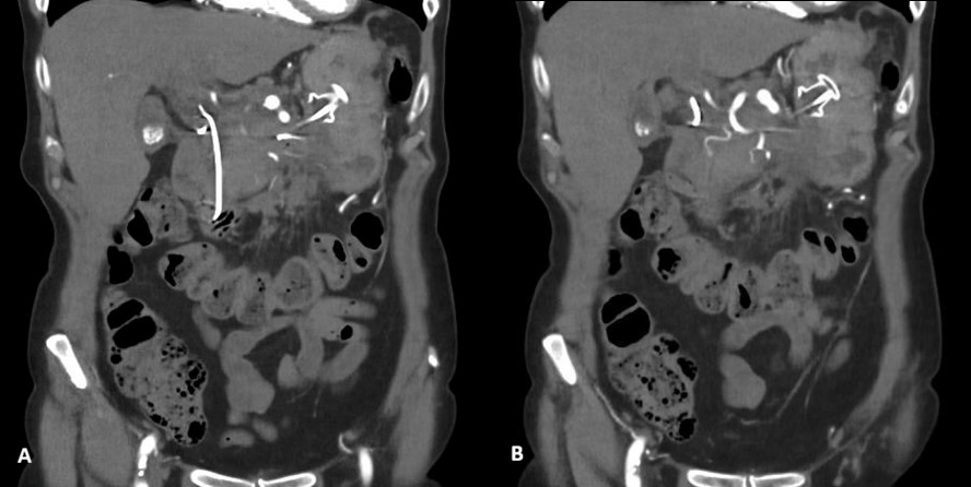 A close-up of an x-ray of a stomach AI-generated content may be incorrect.