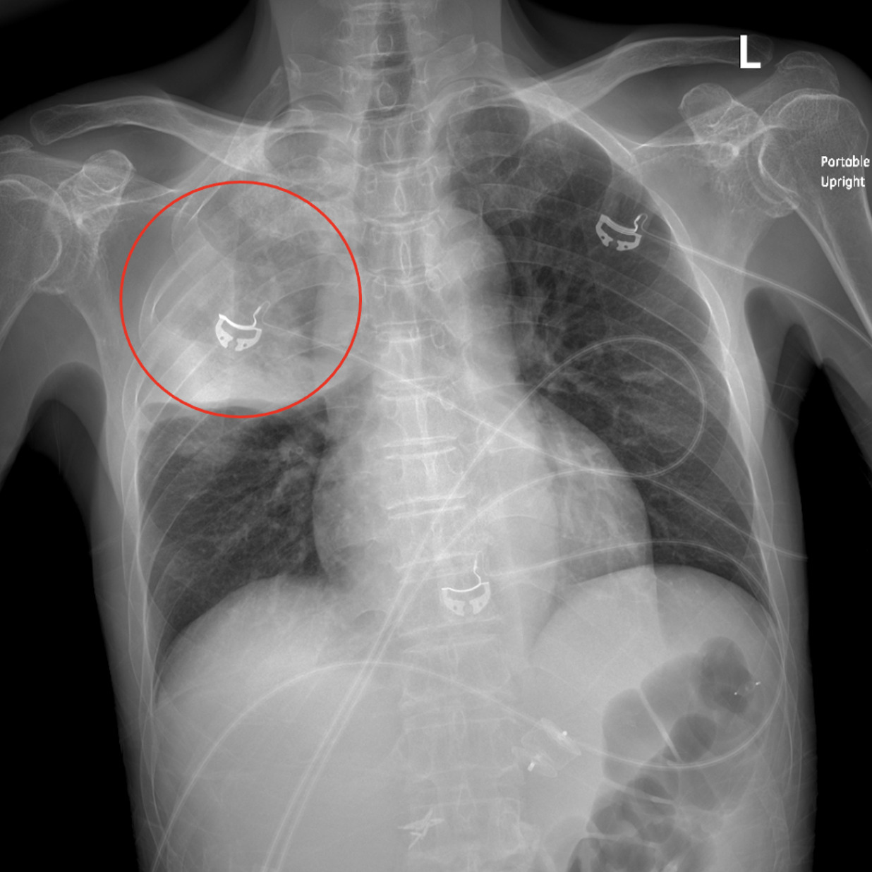 X-ray of a person's chest AI-generated content may be incorrect.