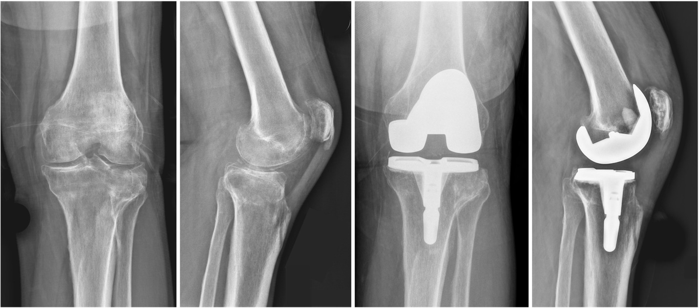 X-ray of a knee and knee joint Description automatically generated