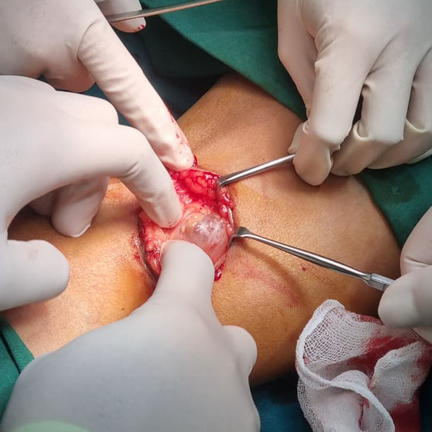 A group of hands performing surgery AI-generated content may be incorrect.