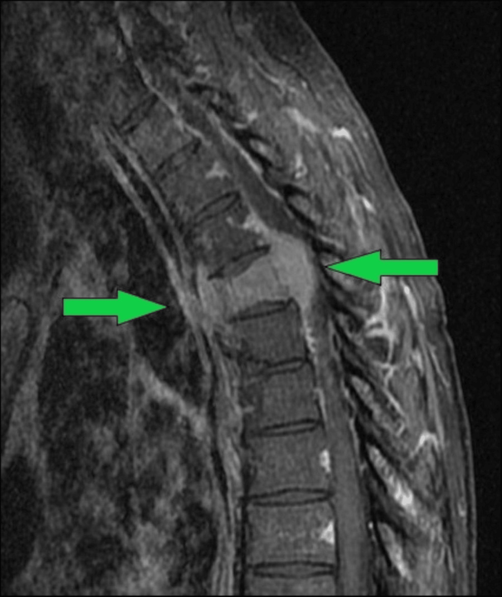 Sagittal-T1-with-fat-suppression-and-intravenous-contrast.-Diffuse-marrow-infiltration-was-noted-within-the-T4-vertebral-body,-with-significant-posterior-expansion,-resulting-in-narrowing-of-the-central-canal-and-compression-of-the-cord.