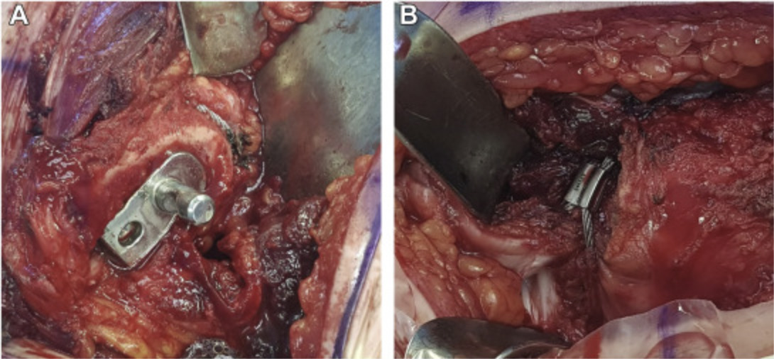 A close-up of a surgery Description automatically generated