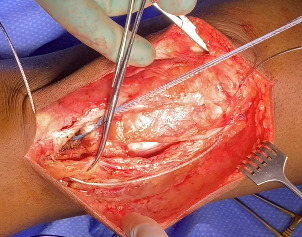 A person's arm with surgical instruments AI-generated content may be incorrect.