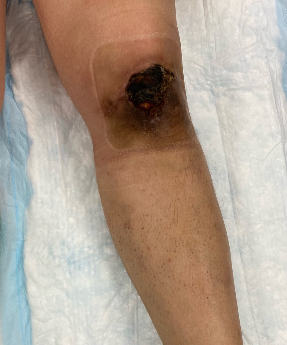 A close up of a knee with a black wound Description automatically generated