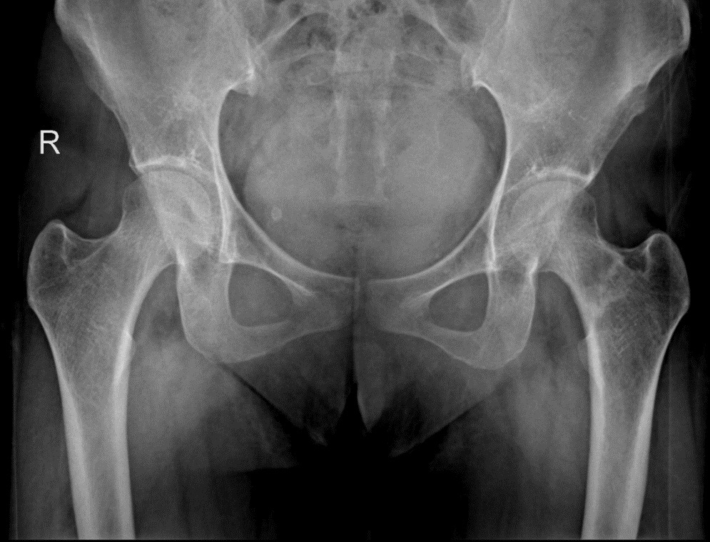 C:UsersdnlieOneDriveDesktopĐinh Ngọc LiêmBệnh nhân nghiên cứuStressed femur fracture (Đinh Hương Thảo)Đinh Hương Thảo.png