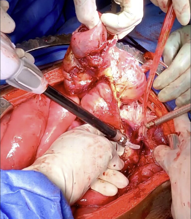 A group of hands performing surgery AI-generated content may be incorrect.