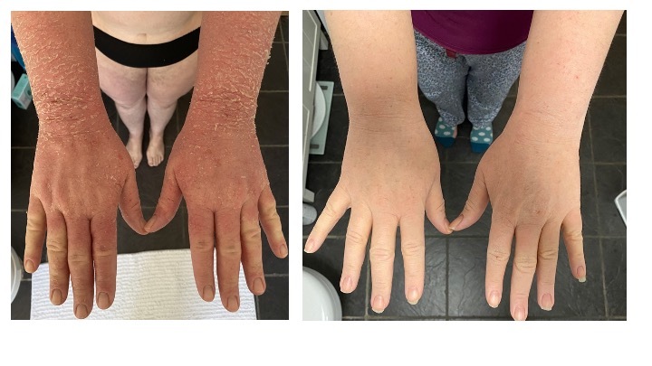 A collage of hands with skin rashes Description automatically generated