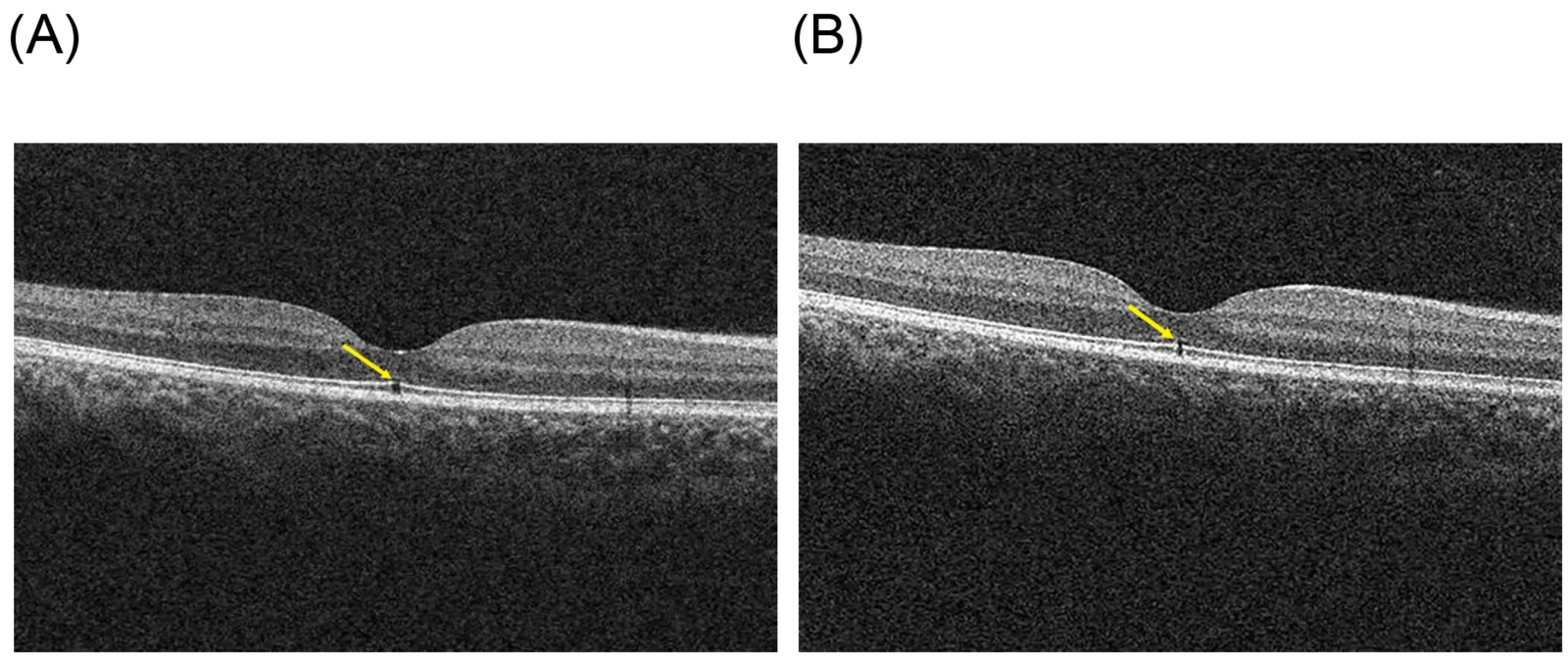 Solar Oct Solar Retinopathy Oct Findings