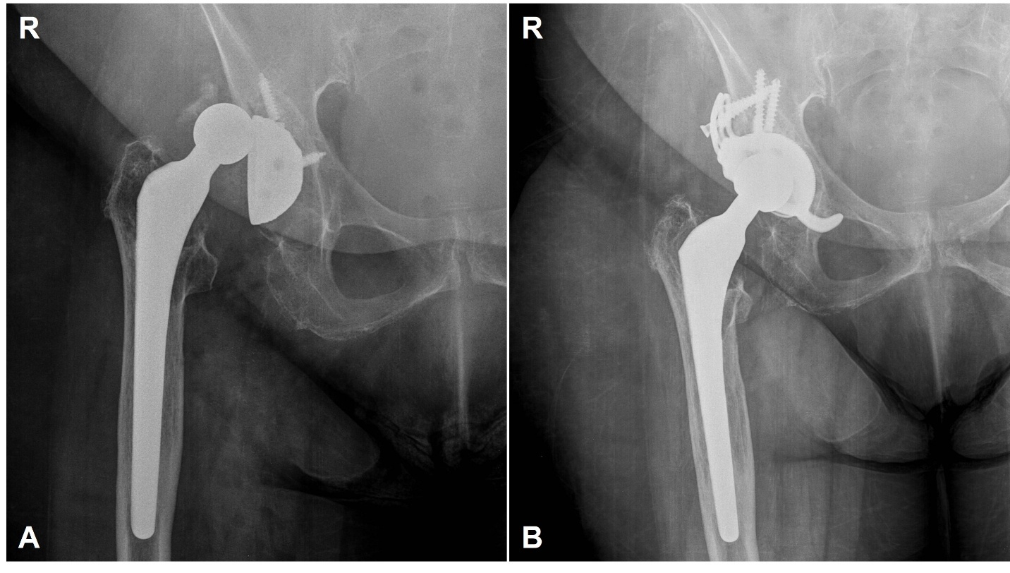 X-ray of a hip joint AI-generated content may be incorrect.