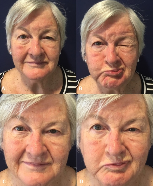 vitamin b12 injections for bell's palsy Botulinum toxin application to the buccinator muscle in the treatment of  facial synkinesis: a prospective cohort study