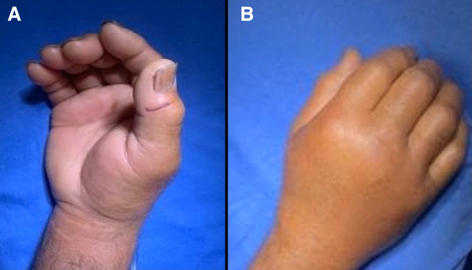 Acute Carpal Tunnel Syndrome Secondary to Reactive Tenosynovitis Following  a Cat Bite: Case Report | Published in SurgiColl
