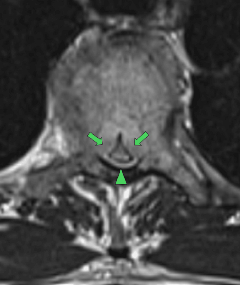 Axial-T2-sequence-at-T4-demonstrating-pathological-marrow-infiltration-with-osseous-expansion-anteriorly-and-posteriorly-(green-arrows).-This-results-in-severe-canal-stenosis-and-spinal-cord-compression-(green-arrowhead).
