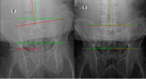 REDUCING ‘CROOKED’ LATERAL SPINE SUBLUXATION (GLOBAL CORONAL IMBALANCE ...