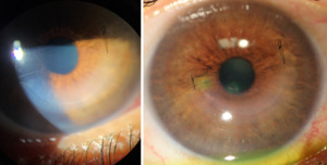 Case Report of Corneal Allogenic Intrastromal Ring Segment (CAIRS) in a ...
