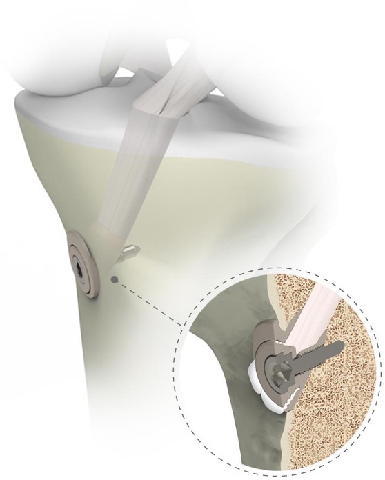 A close-up of a knee joint AI-generated content may be incorrect.